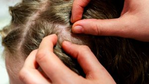 What Do Lice Bites Look Like on a Child’s Scalp?