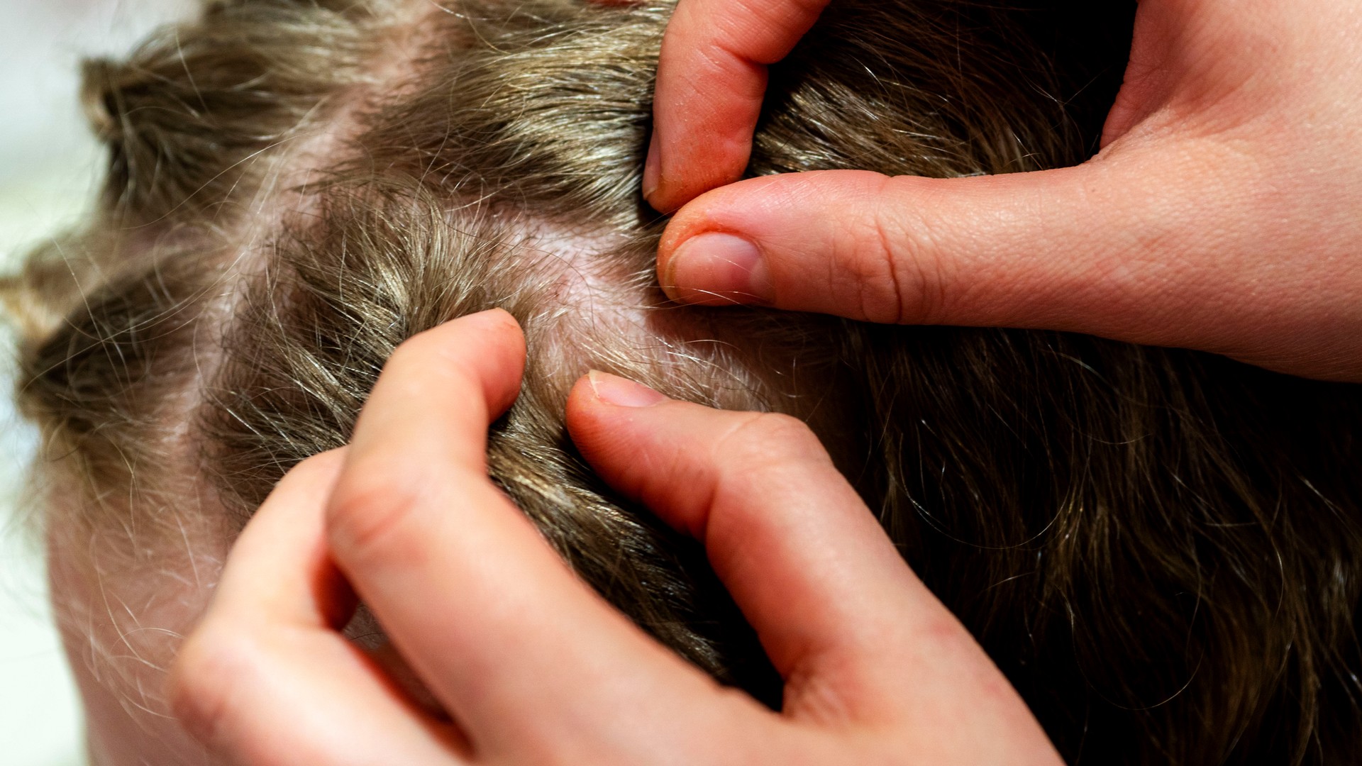 What Do Lice Bites Look Like on a Child’s Scalp?