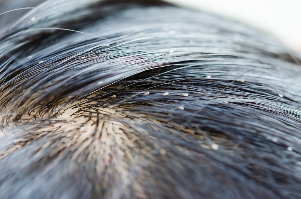 What Happens If You Have Head Lice For Too Long?
