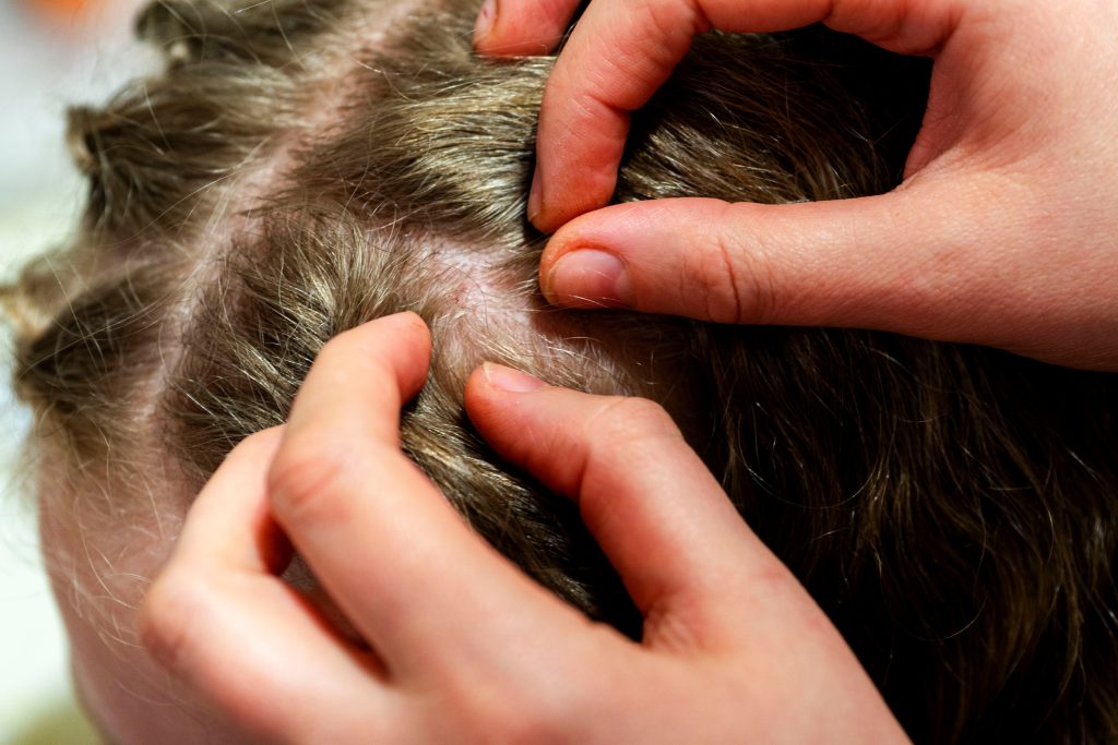 How One Head Louse Becomes a Full Infestation