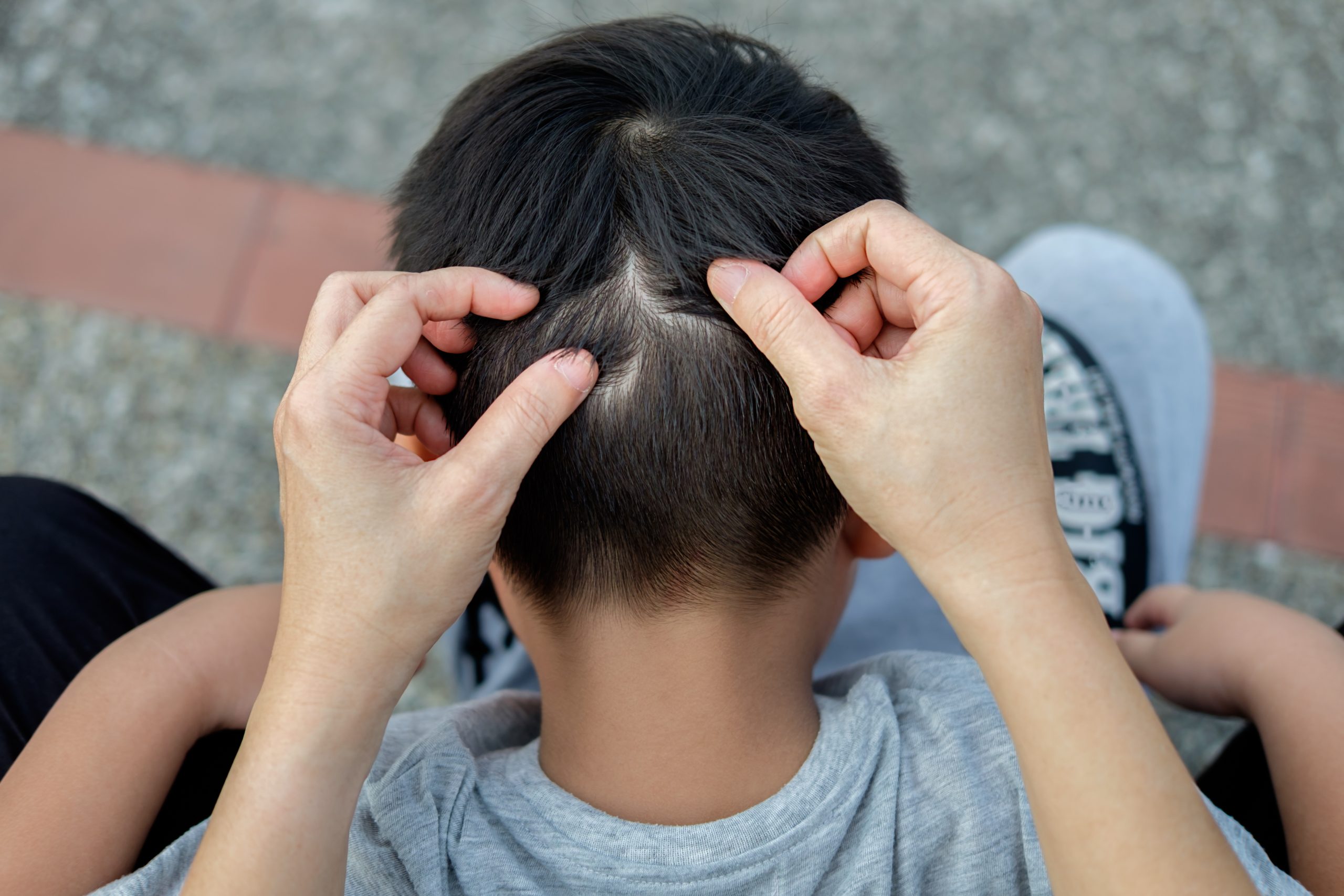 Does Vinegar Kill Head Lice? What The AAP Says