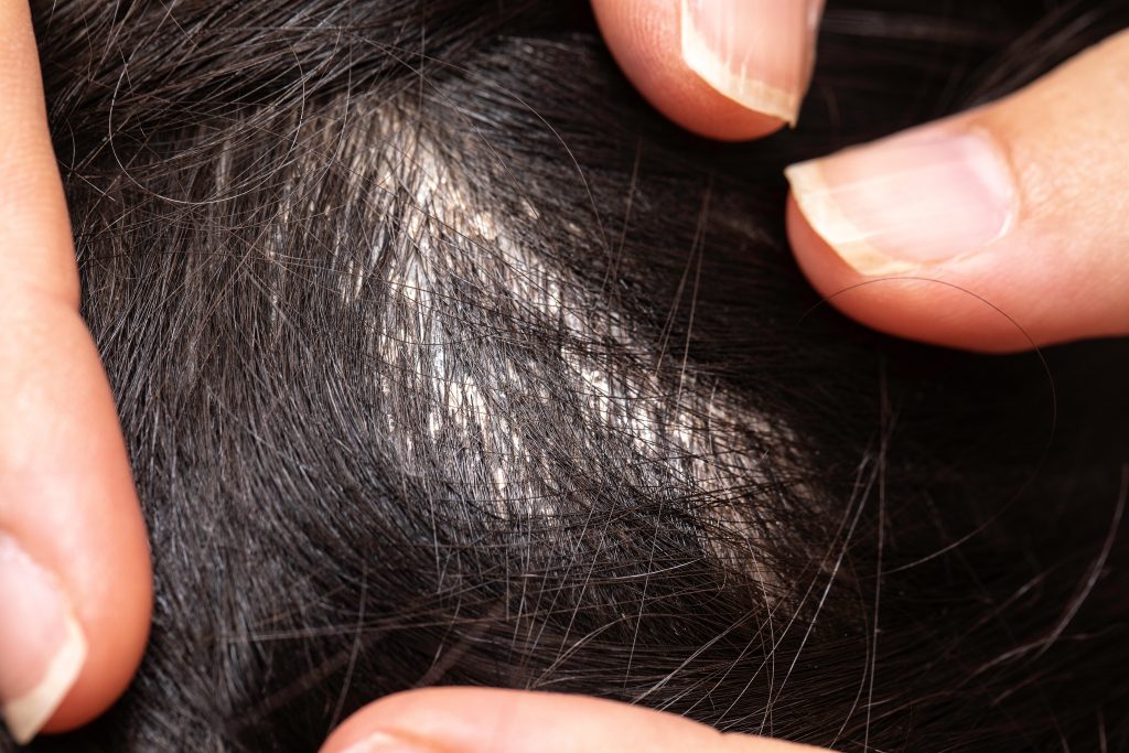 Feeling Overwhelmed by Head Lice? You’re Not Alone
