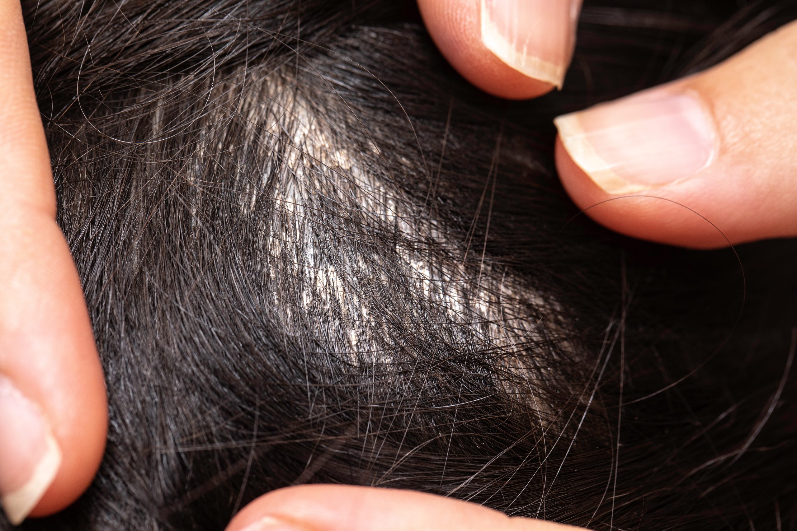 Close-up of hair being parted during a careful head lice inspection.