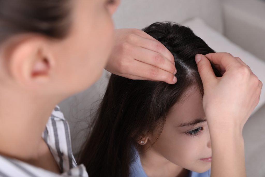 Lice vs Dandruff: How to Tell the Difference