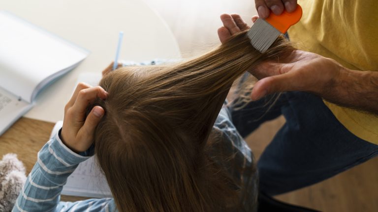 Black Specks in the Hair Mean Lice Are Feeding Now